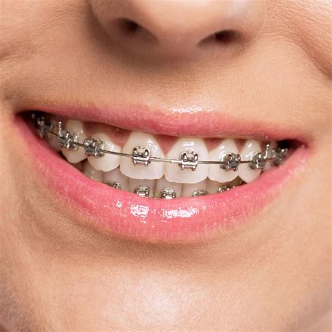 metal bracket in mouth|do orthodontics use metal brackets.